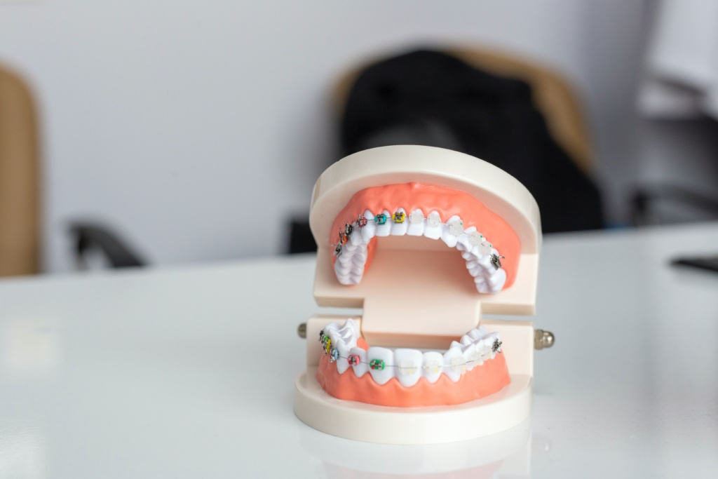 Do Braces Fix An Open Bite? Gisborne Family Dental