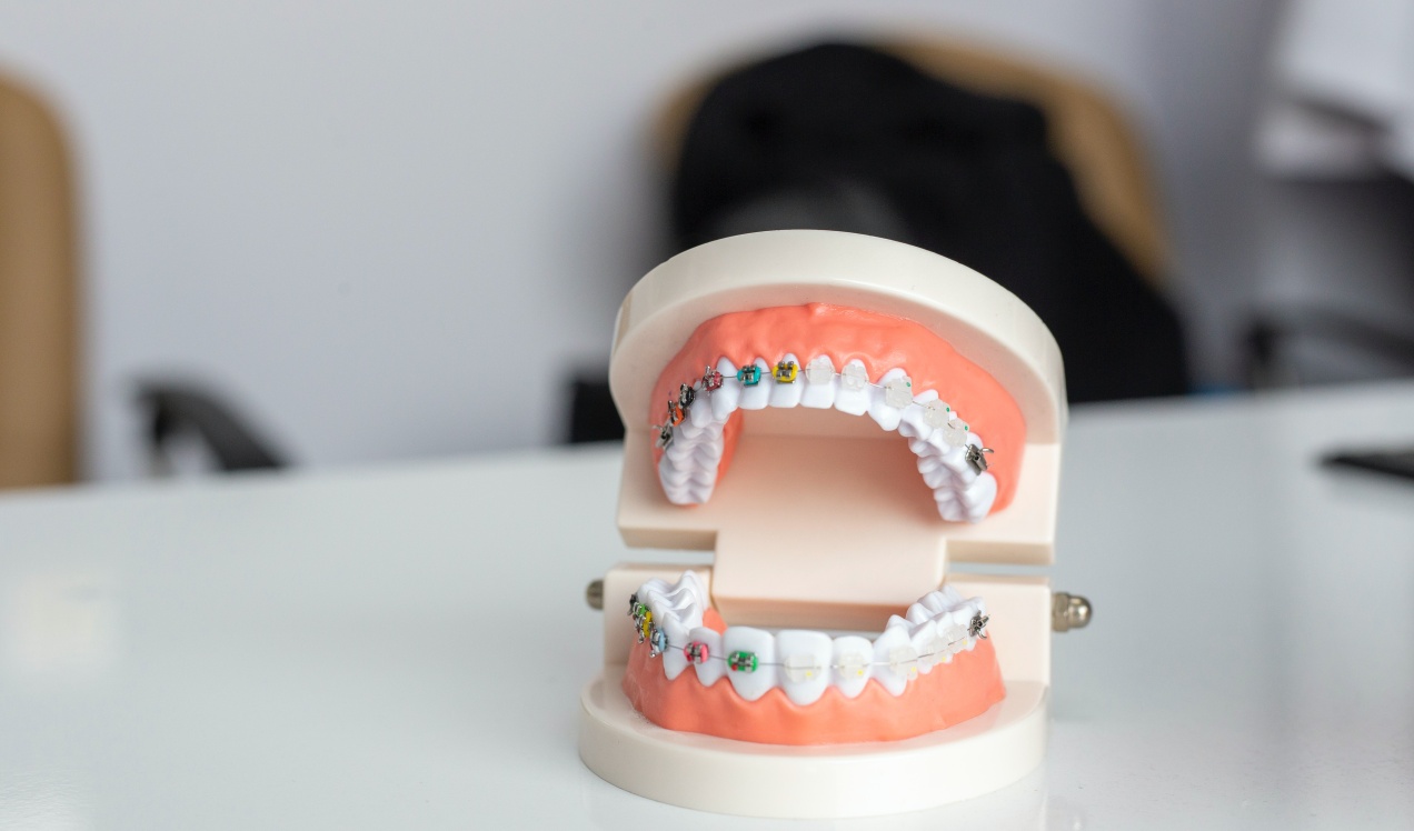 Braces Fix Open Bite