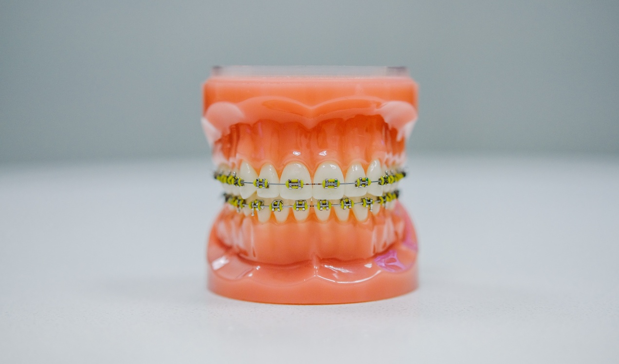 Invisalign Vs Braces
